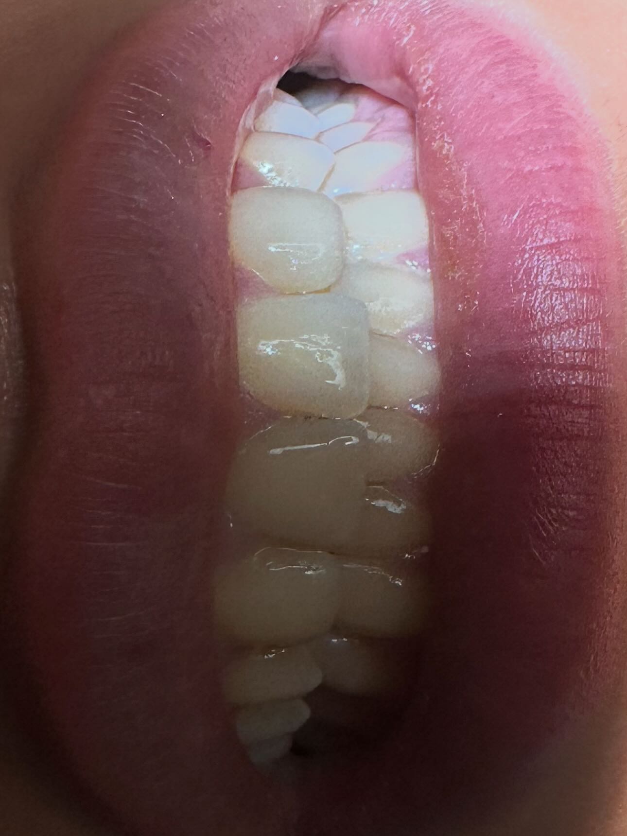 Före tandblekning hos D-dental i Tyresö – närbild på tänder