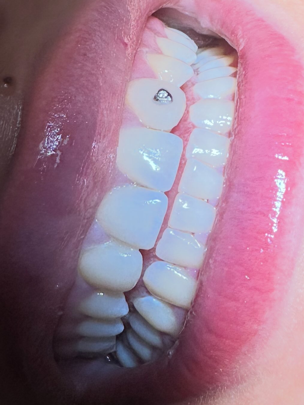 Efter tandblekning hos D-dental i Tyresö – ljusare, naturligt resultat